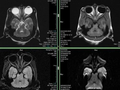 Parkinsons sjukdomsmodell